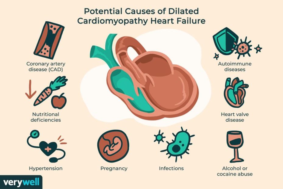 Dilated Cardiomyopathy Symptoms, Causes, Diagnosis, And Treatment