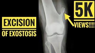 Excision Of Exostosis/Osteochondroma - Youtube